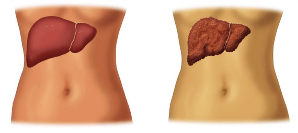 žltačka typu C je tichý zabijak